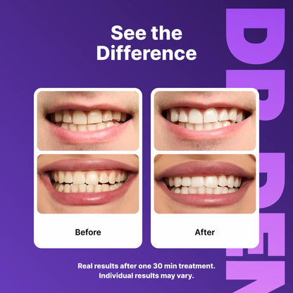 Purple Teeth Whitening Strips Enamel safe and Peroxide Free